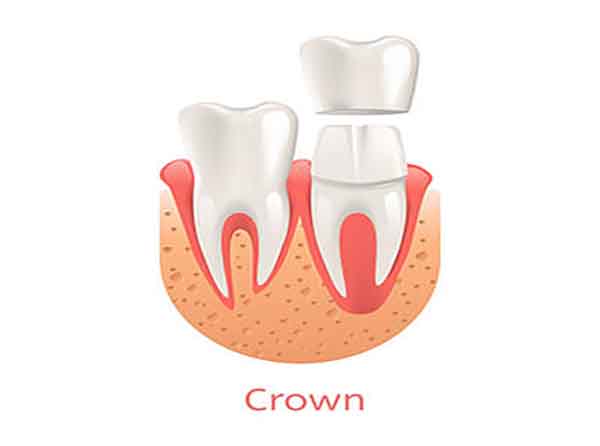 dental crown