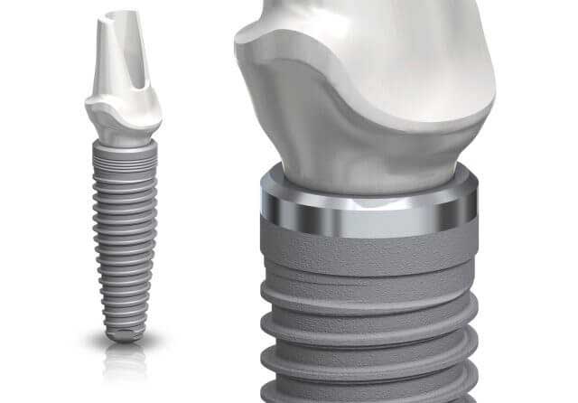 titanium implant