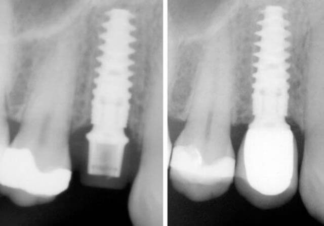 Implant insert