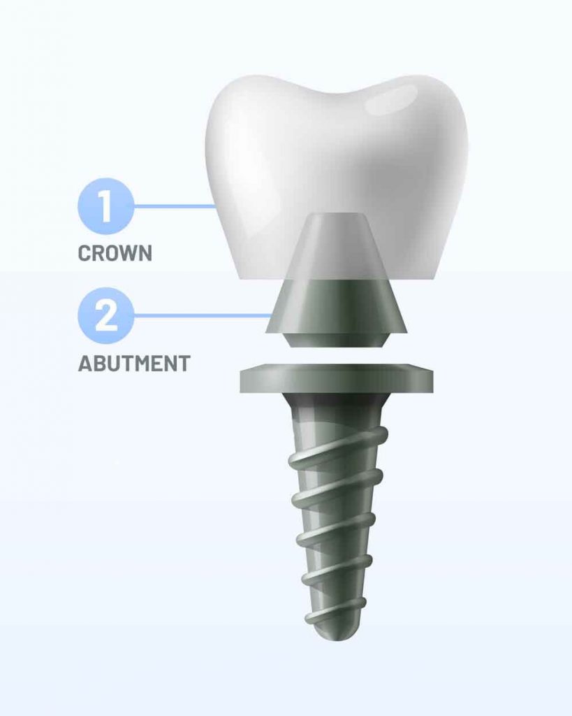 dental implant