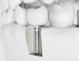 Stages of a dental implant