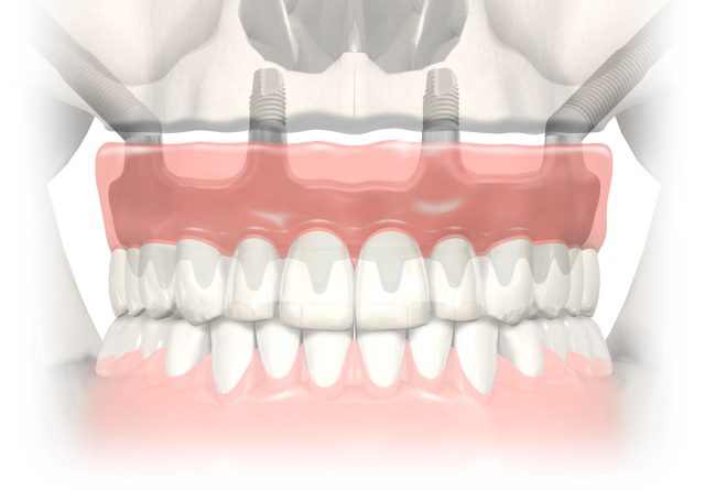 dental implant