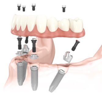 dental implant