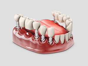 bridge implant denture